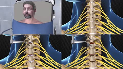 3D颈椎病前路减压融合手术