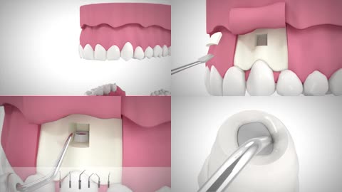 3D口腔科根尖切除术动画视频