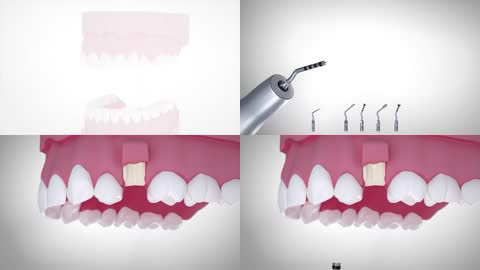 3D口腔科牙槽嵴抬升手术动画