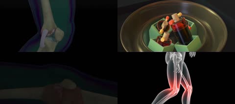 3D医疗膝盖手术动画