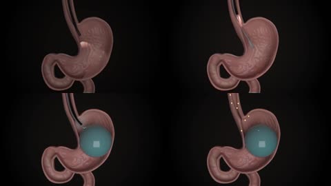 3D胃内球囊放置减肥手术