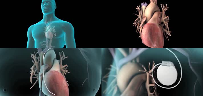 3DICD植入技术医疗视频