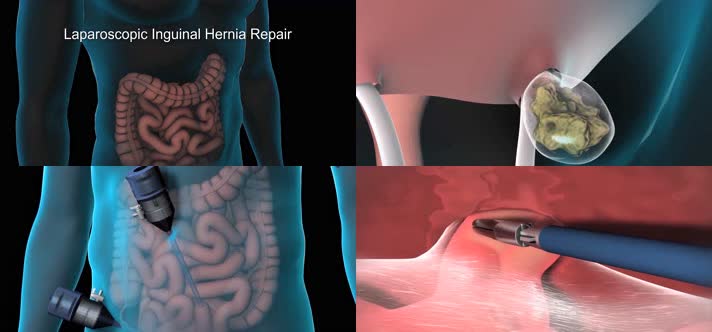 3D腹股沟疝修补术手术医疗视频