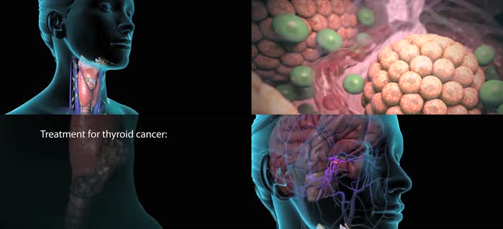 3D甲状腺癌化疗类型甲状腺癌医疗视频
