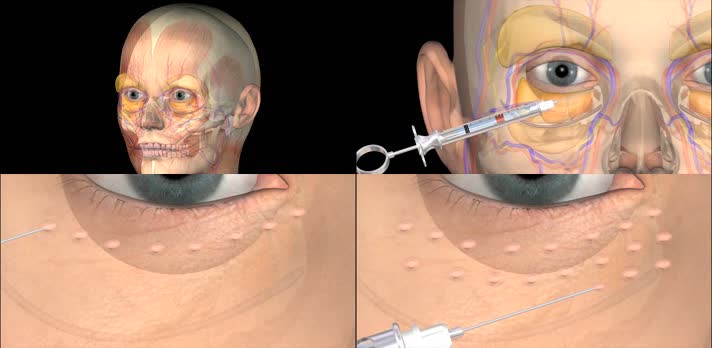 3D整形美容注射面部三维医疗动画