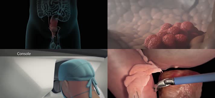 3D前列腺癌前列腺切除术肿瘤医疗视频
