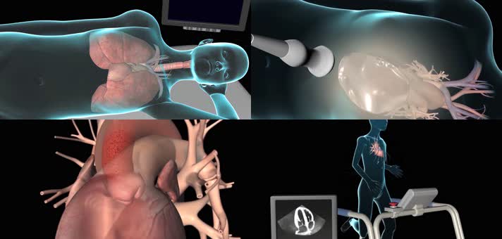3D超声心动图检测医疗视频