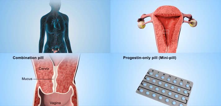 3D采取黄体酮防止怀孕医疗视频