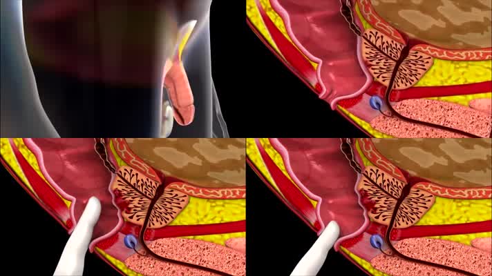 3D前列腺癌直肠指医疗视频