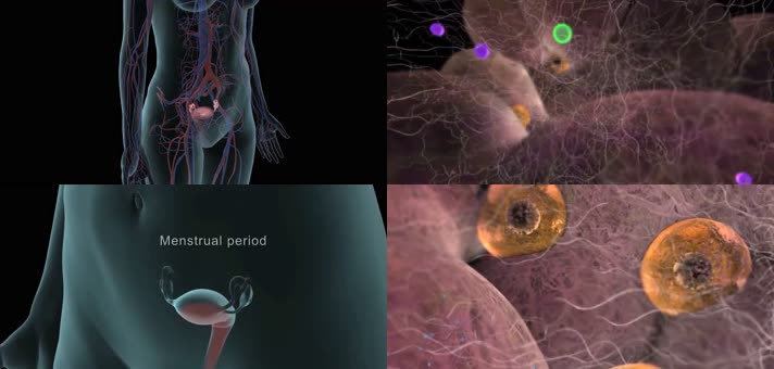 3D多囊卵巢综合征医疗视频