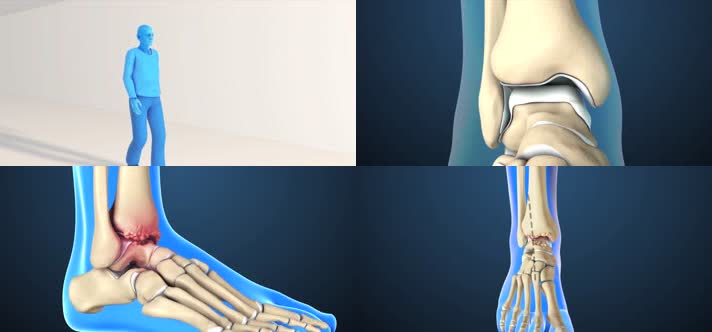 3D关节炎全踝关节置换手术医疗视频