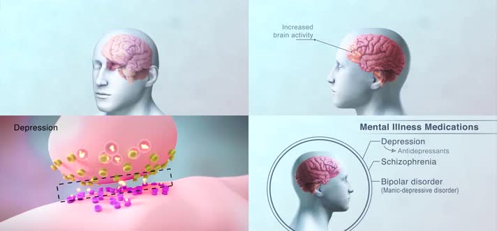 3D精神疾病治疗医疗视频