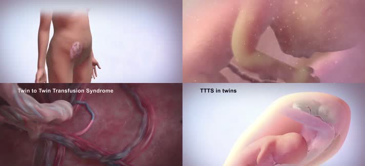 3D医疗双胎输血综合征并发症