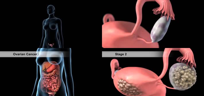 3D卵巢癌盆腔疼痛腹部肿胀医疗视频