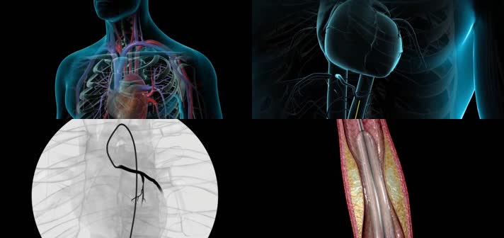 3D冠状动脉腔内成形术医疗视频