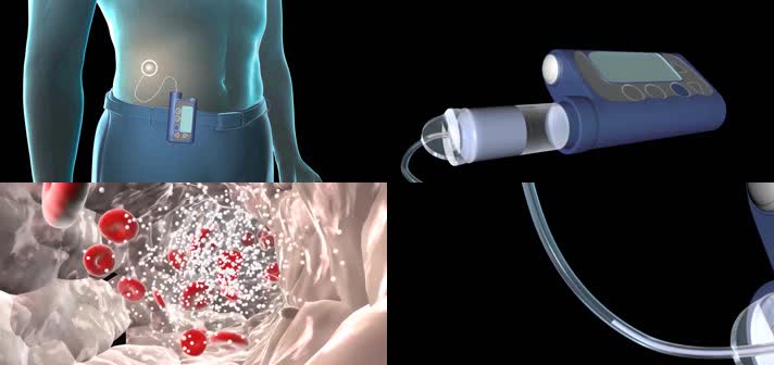 3D胰岛素泵工作医疗视频
