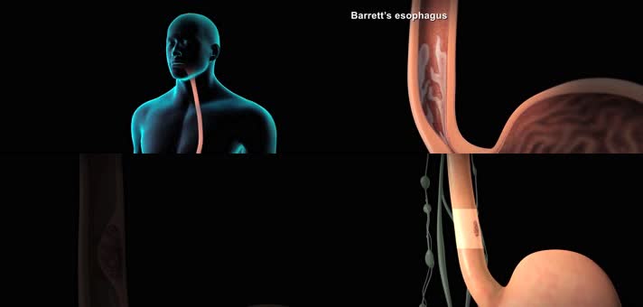 3D食道癌过渡医疗视频