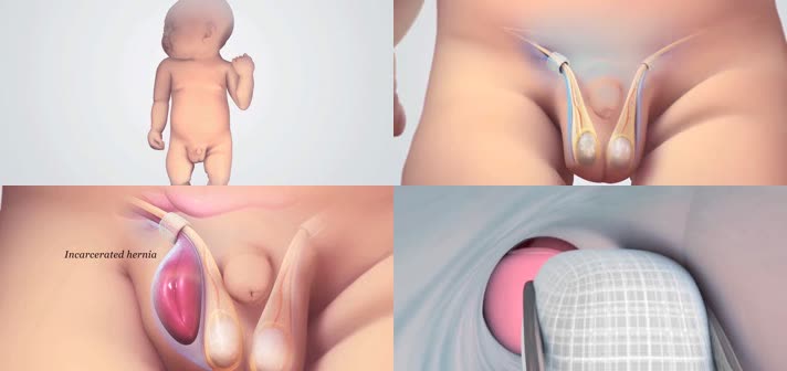 3D婴儿腹股沟疝修补手术医疗视频