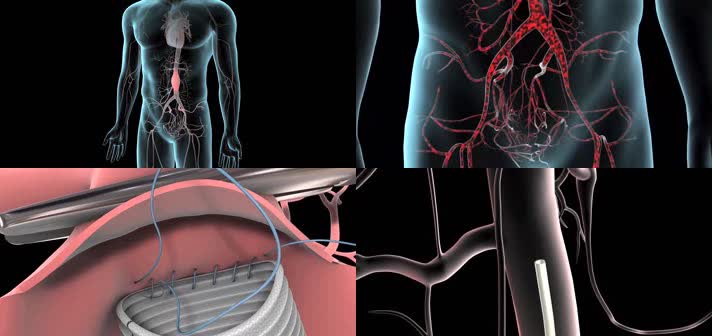 3D腹主动脉瘤修复医疗视频