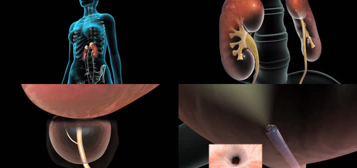 3D膀胱镜检查技术泌尿系统医疗视频