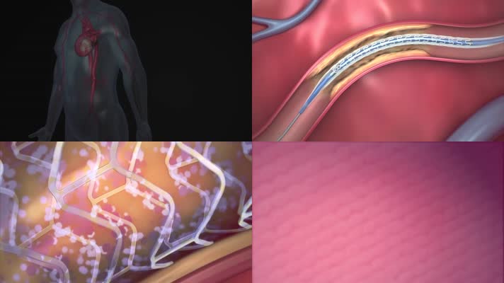 心脏治疗心脏手术3D三维动画