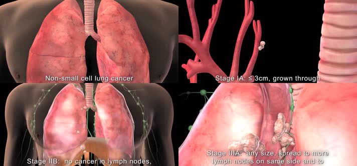 3D肺癌进展分段医疗视频