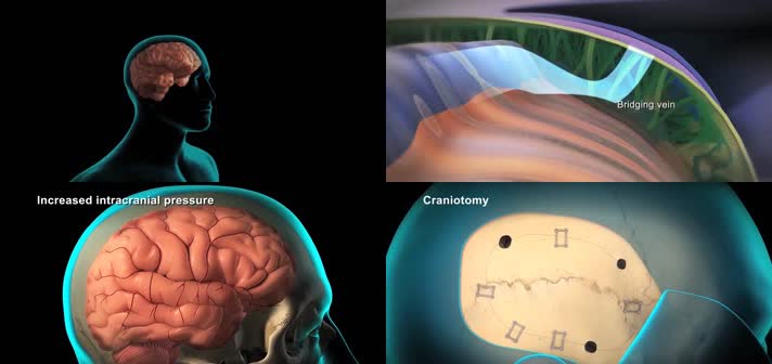 3D颅脑切开手术脑外科创伤性脑损伤医疗