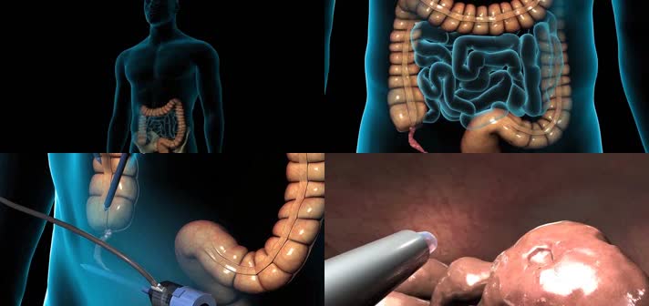 3D腹腔镜阑尾切除术手术医疗视频