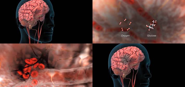 3D脑血管中风医疗视频