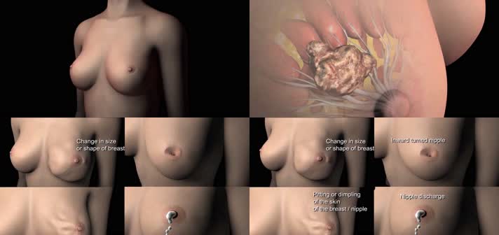 3D乳腺癌症状医疗视频