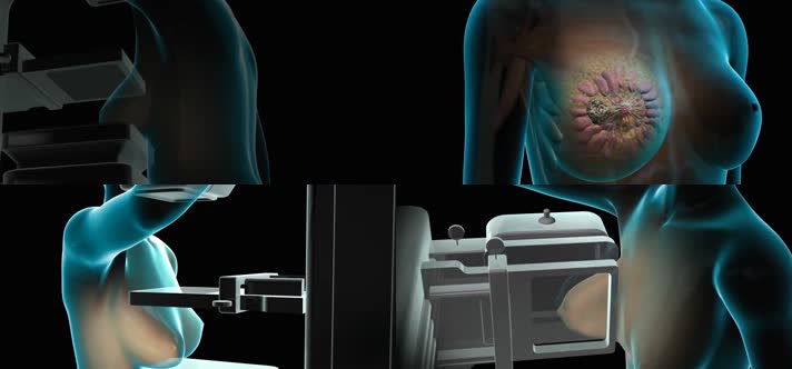 3D乳腺切除手术医疗视频