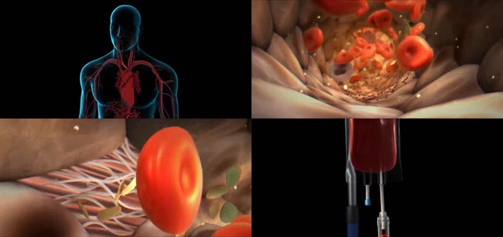 3D输血程序医疗视频