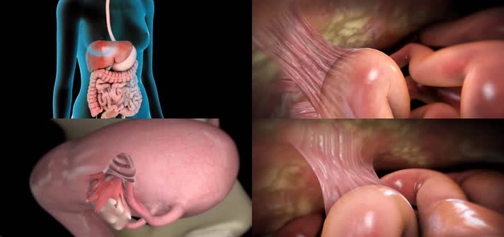 3D腹腔镜腹部粘连溶解医疗视频