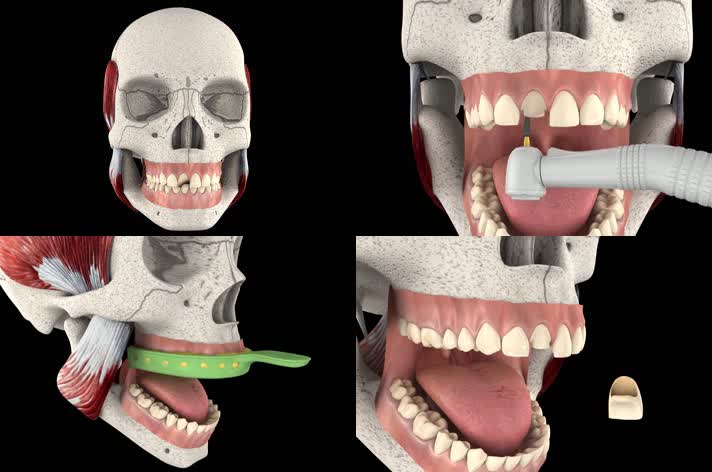 3D牙科补牙动画