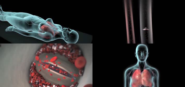 3D深静脉血栓形成肺栓塞医疗视频