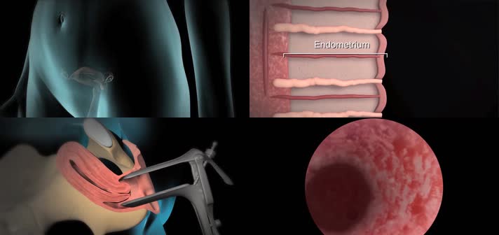 3D宫腔镜医疗视频