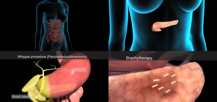 3D胰腺癌医疗视频