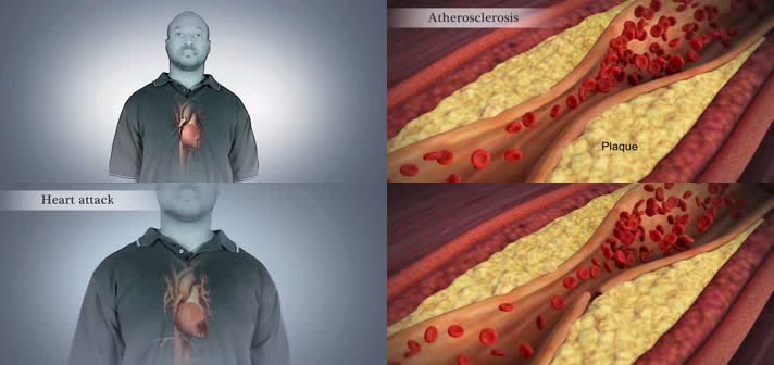 3D急性冠状动脉综合征医疗视频