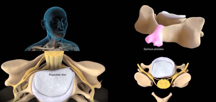 3D融合脊柱医疗视频