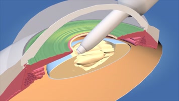 白内障眼科手术医疗动画 白内障眼科手术医疗动画