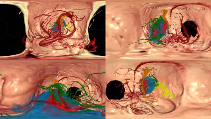 VRAR虚拟现实脑出血医疗视频