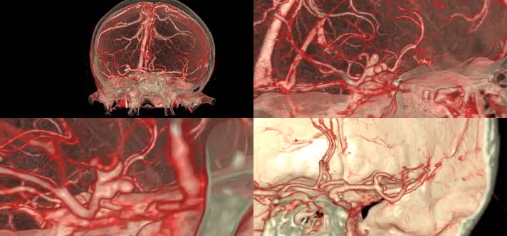 VR虚拟现实短动脉瘤医疗视频
