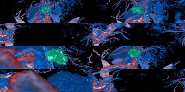 VRAR虚拟现实脑瘤医疗视频
