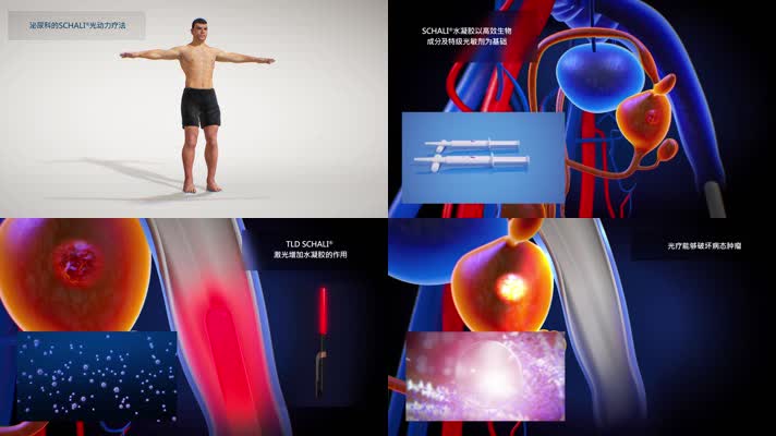 男性泌尿系统光动疗法医疗三维机理动画