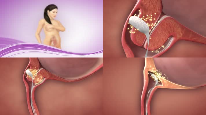 诱导宫颈成熟孕妇胎儿医疗三维机理动画