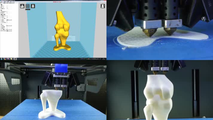 人体骨骼关节3D打印技术医疗科技