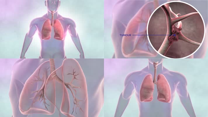 肺癌治疗三维机理动画医疗科技