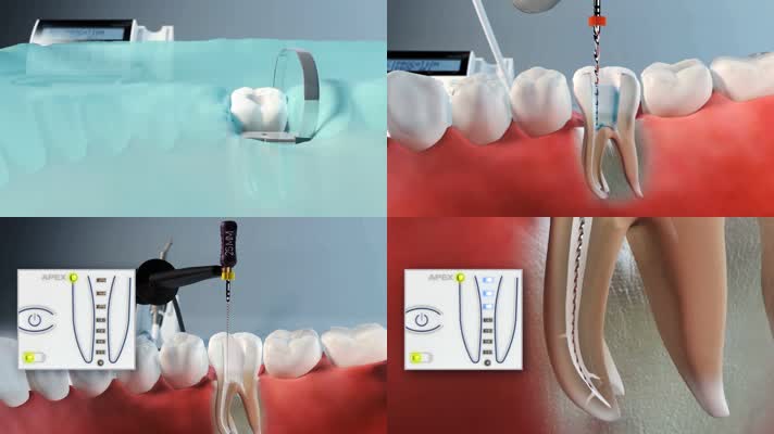 补牙牙齿修复3D动画