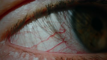 红眼病，红色眼睛，眼睛血丝