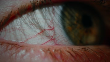 红眼病，红色眼睛，眼睛血丝